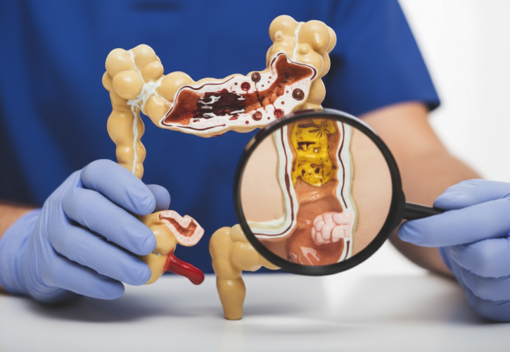 Cancro del Colon-Retto: Importanza della Diagnosi Precoce e Sintomi da Non Sottovalutare