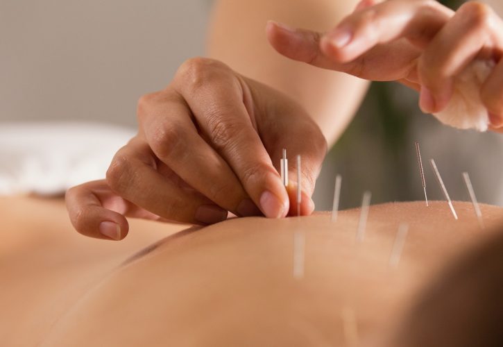 L’Agopuntura: Da Medicina Alternativa a Terapia Riconosciuta
