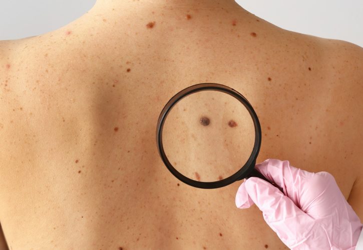 Tumori della pelle e invecchiamento cutaneo: i dermatologi riscrivono le regole della protezione solare